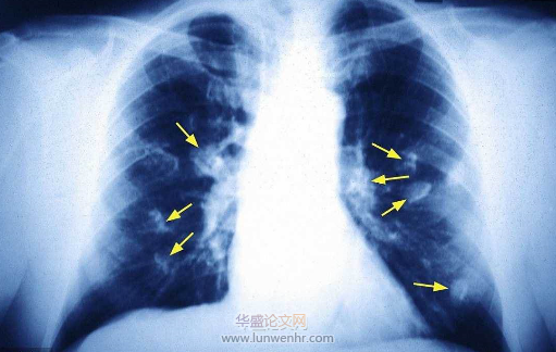 精神疾病肺内磨玻璃结节影像学